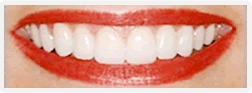 whiter smile